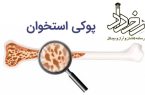 🔹افزایش عارضه پوکی استخوان در کاشان